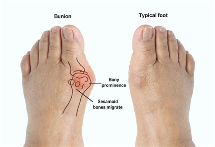 Are bunions caused by ill fitting shoes?