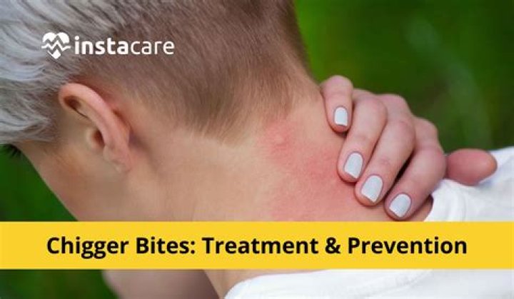 Are chigger bites painful?