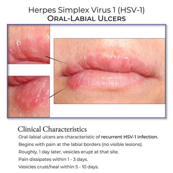 Are herpes itchy at first?