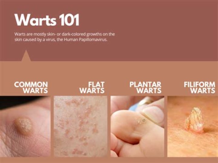 Are mosaic warts contagious?