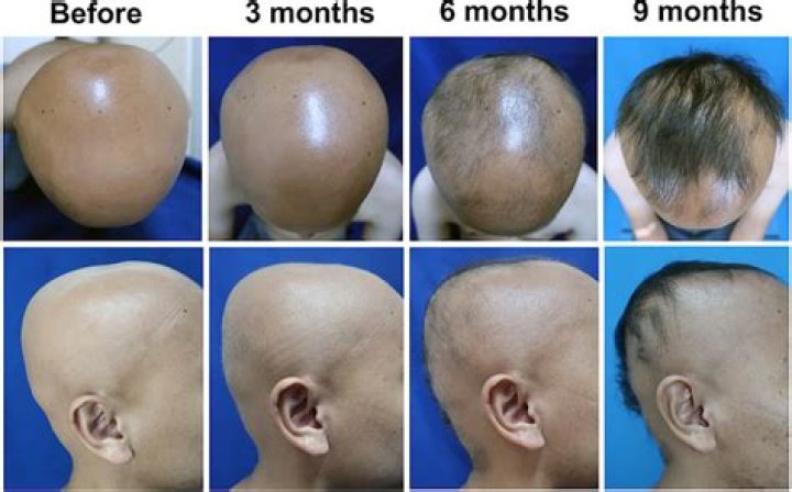 Can alopecia be treated?