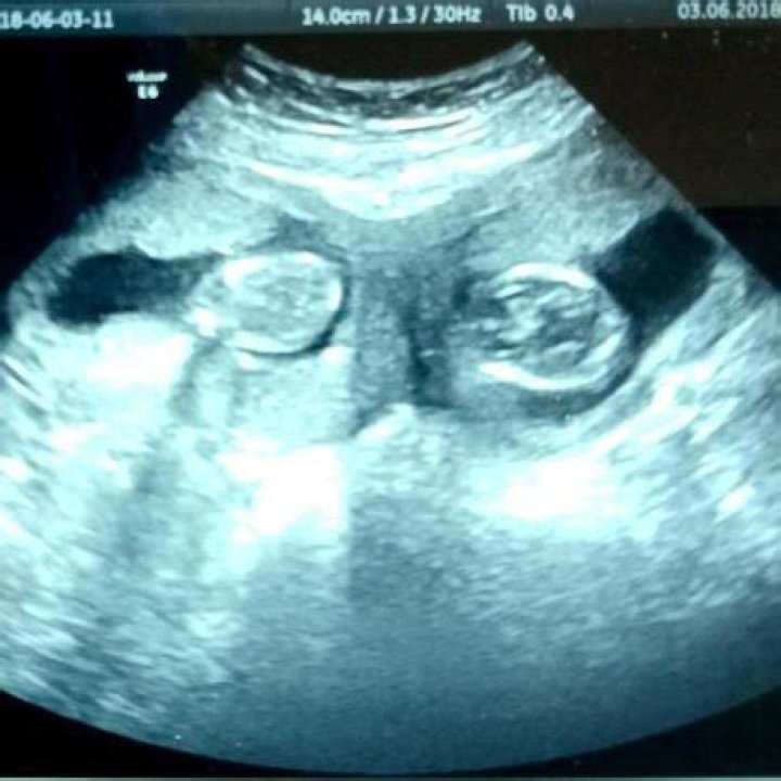 Can bicornuate uterus cause twins?
