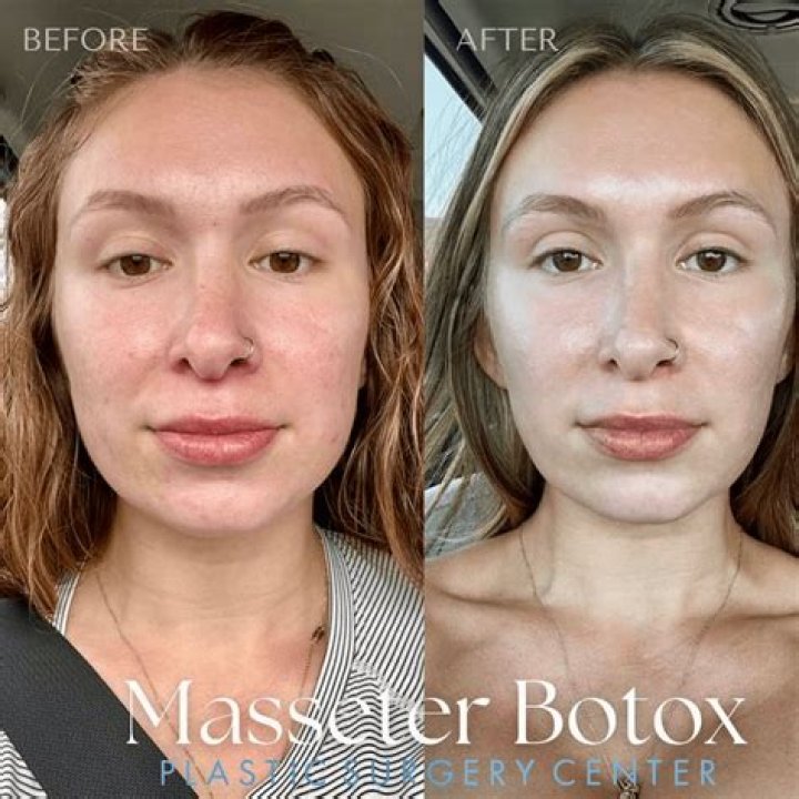 Can botox mess up your face?