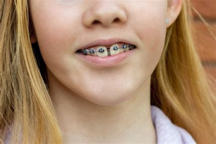Can braces fix gapped teeth?