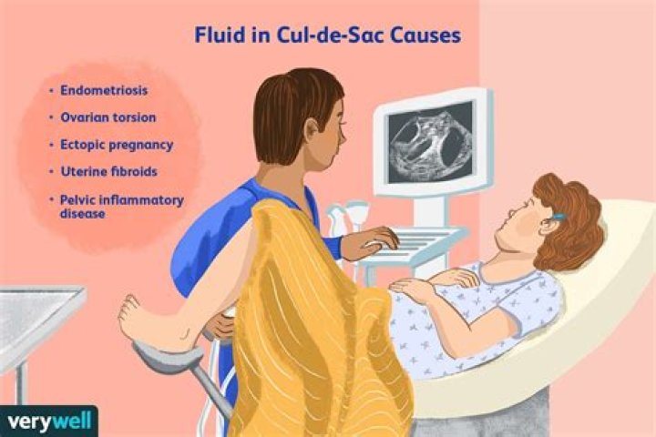 Can fluid in the cul-de-sac cause pain?