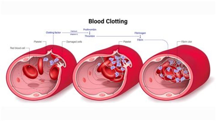Can girdles cause blood clots?