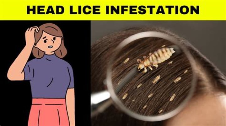 Can having lice kill you?