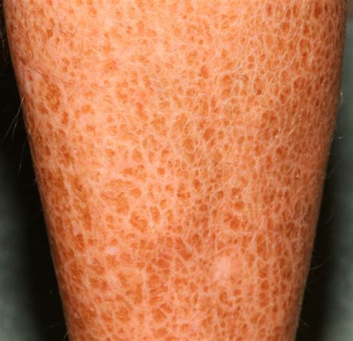 Can ichthyosis vulgaris spread?