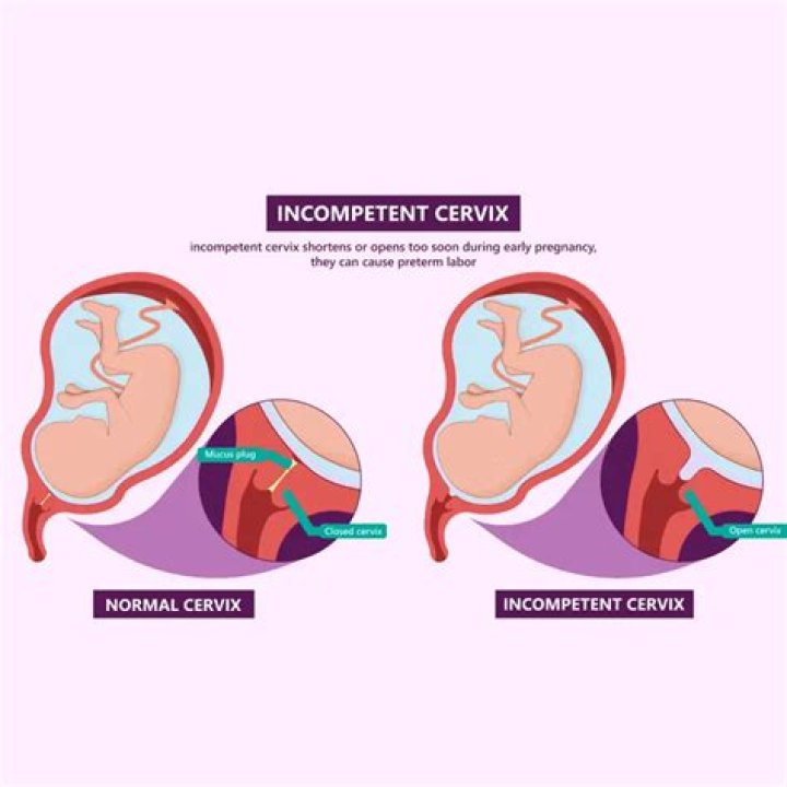 Can incompetent cervix happen again?