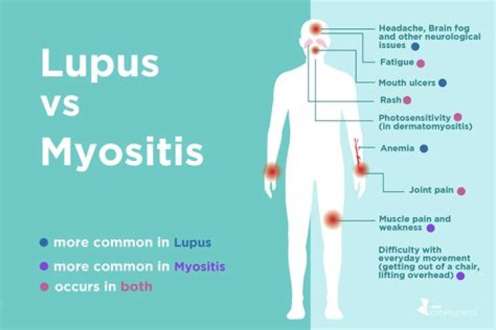 Can lupus cause myositis?
