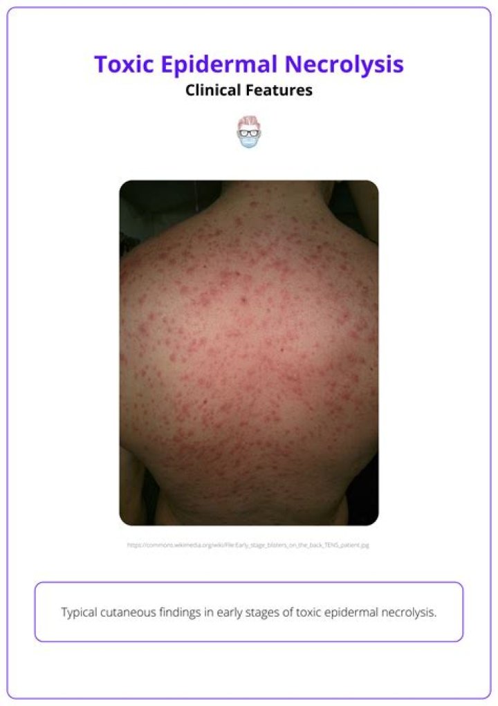 Can toxic epidermal necrolysis be cured?