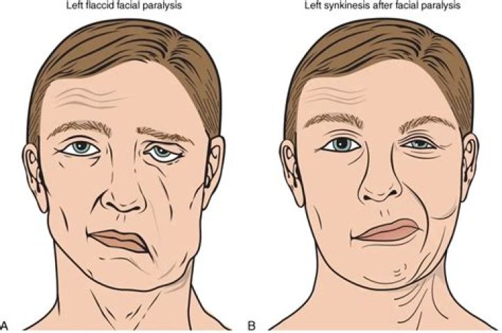 Can you die from bulbar palsy?