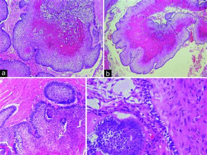 Can you reverse keratinization?