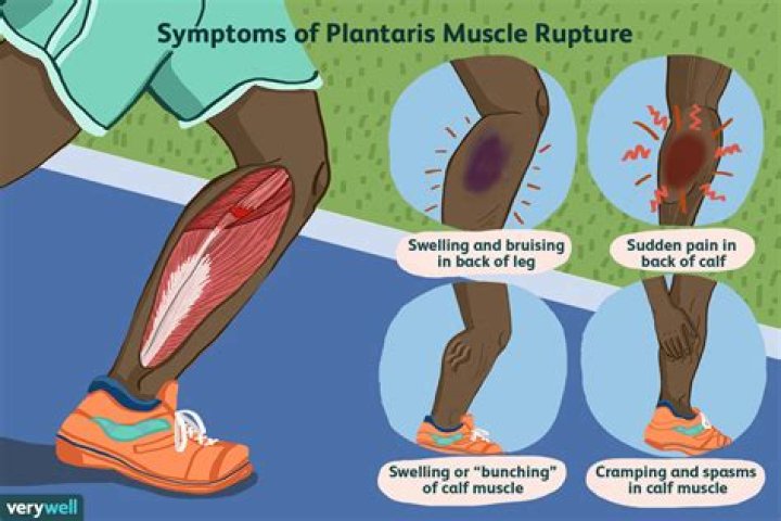 Can you tear your plantaris?