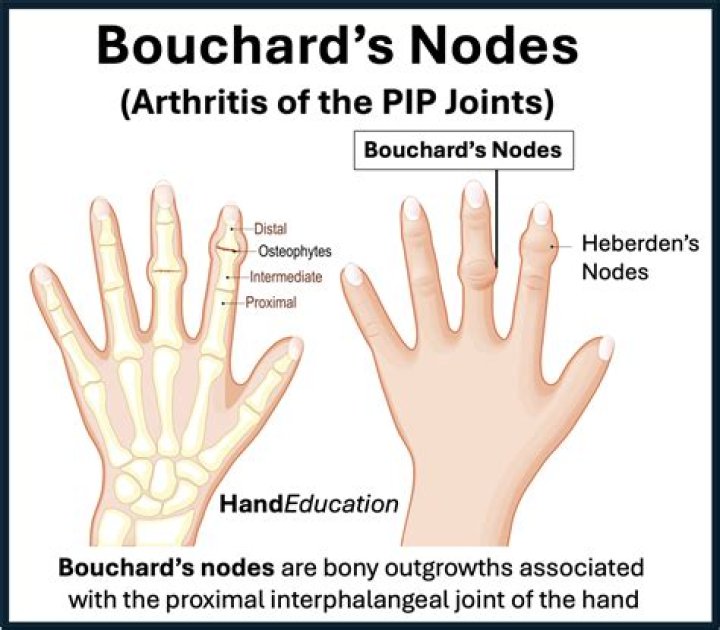Do bouchard's nodes go away?
