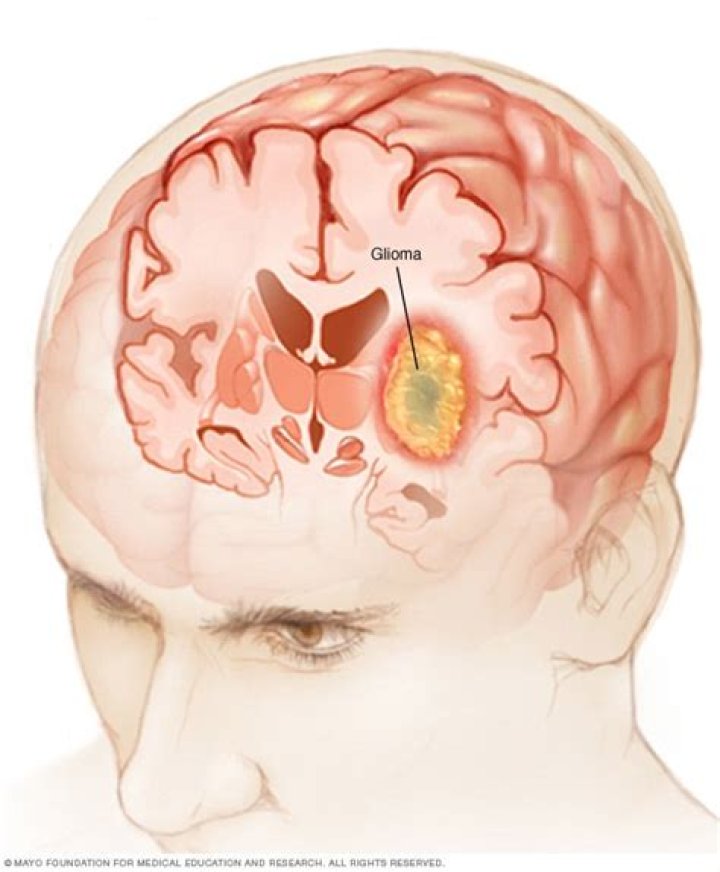 Do gliomas always come back?