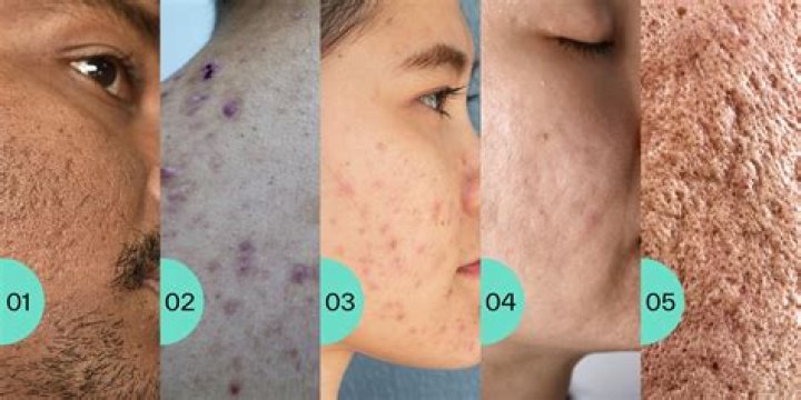 Do scarring go away?