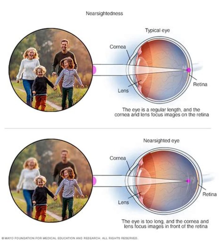 Do screens cause short sightedness?