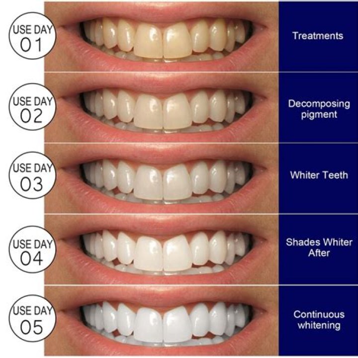 Do whitening strips remove plaque?