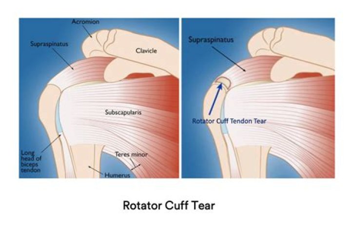 Does a supraspinatus tear require surgery?