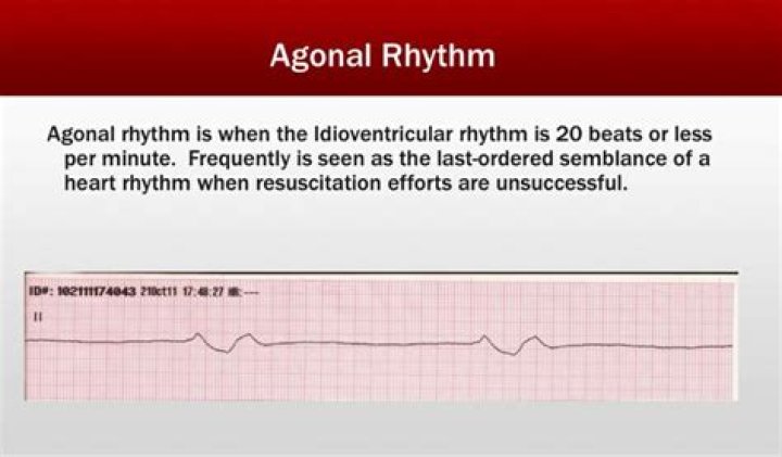 Does an agonal rhythm have a pulse?