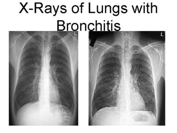 Does bronchitis show up on xray?