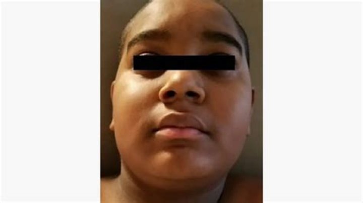Does budesonide cause moon face?