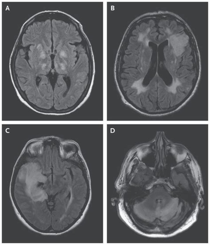 Does encephalitis show up on mri?