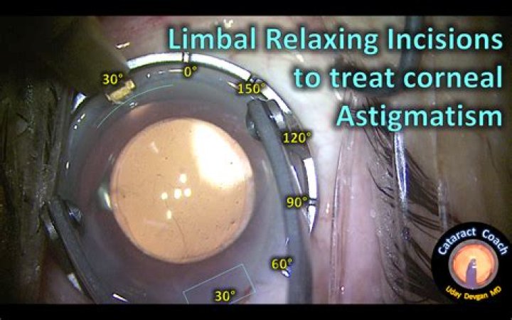 Does medicare cover limbal relaxing incision?