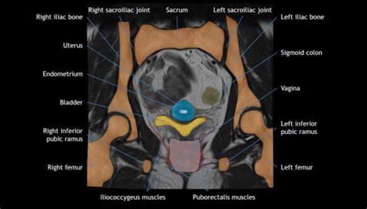 Does mri pelvis show sacrum?