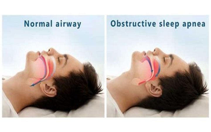 Does obstructive sleep apnea cause high blood pressure?