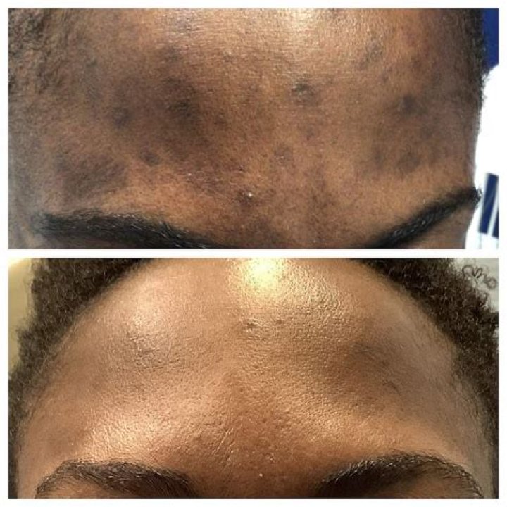 Does vivace help with hyperpigmentation?
