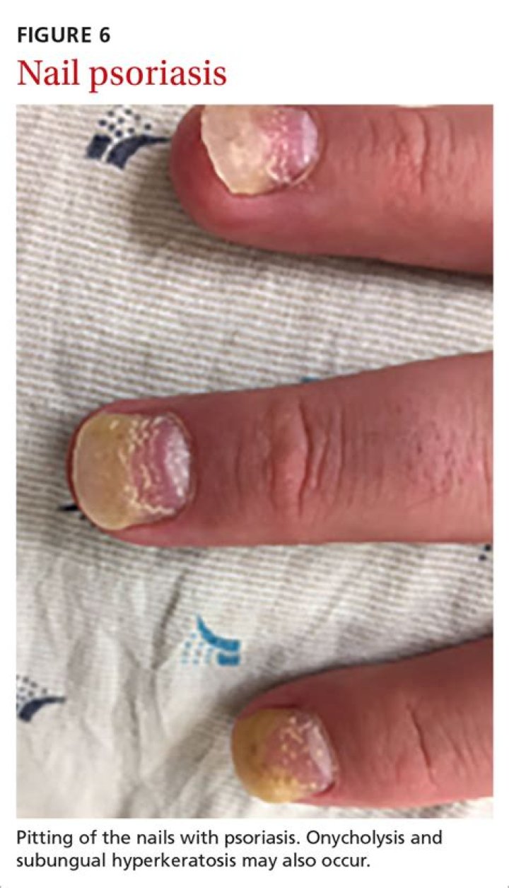 How do you treat hyperkeratosis?