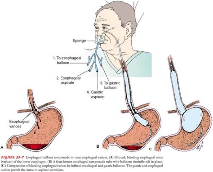 How esophageal varices develop?