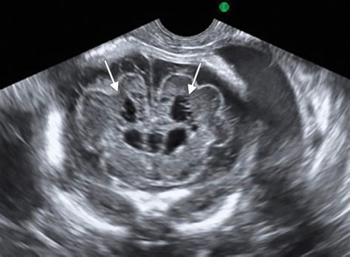 How is porencephaly inherited?