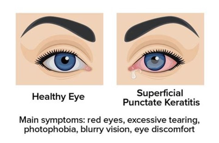 How is superficial punctate keratitis treated?
