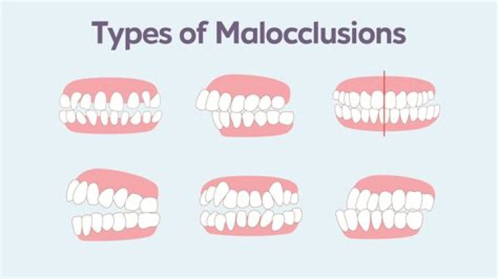 How to fix malocclusion?