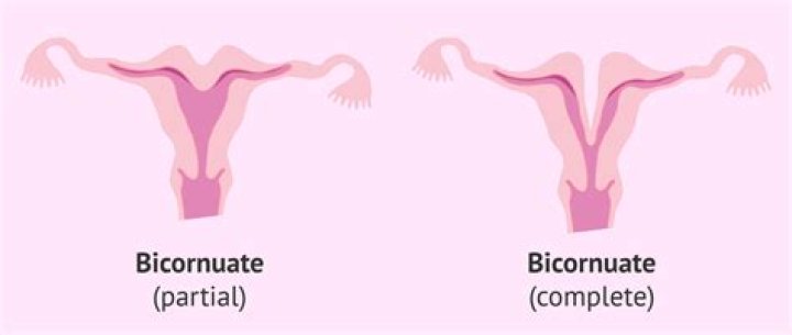 Is bicornuate uterus genetic?