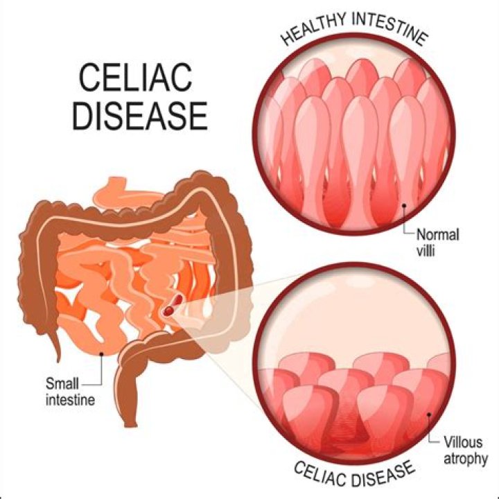 Is celiac disease fatal?