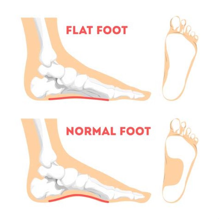 Is flat footed bad?