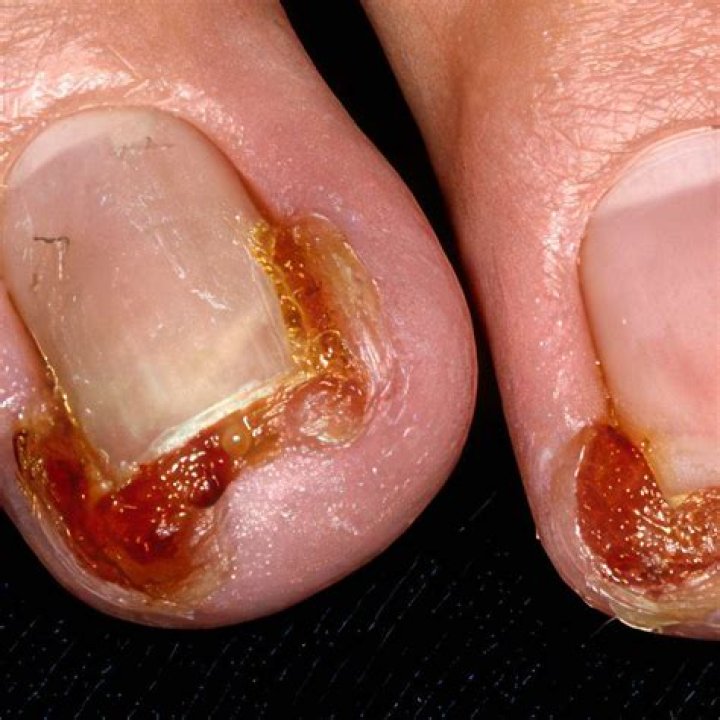 Is paronychia fungal or bacterial?