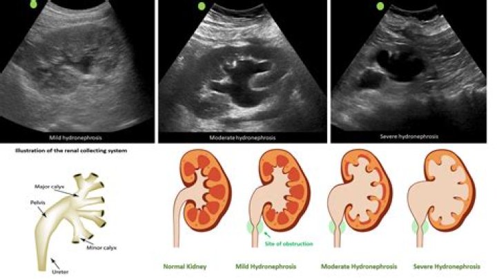Should an atrophic kidney be removed?