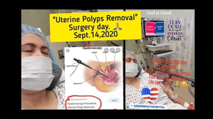 Should you have uterine polyps removed?