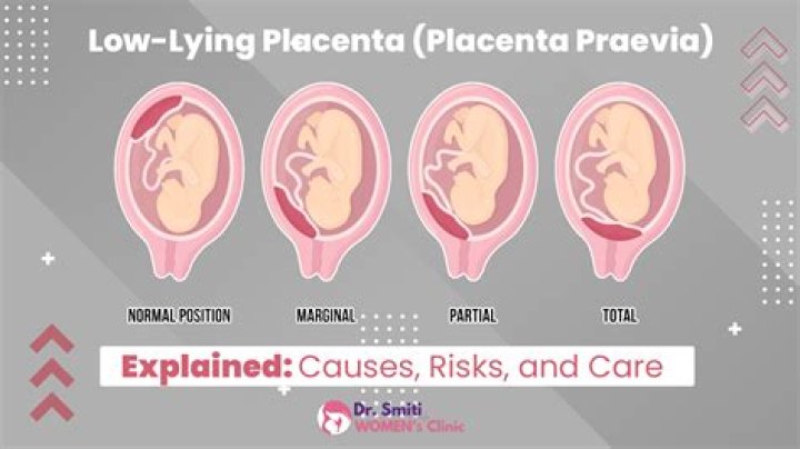 Should you rest with a low lying placenta?