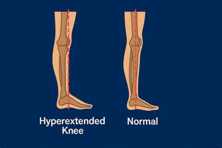What are hyperextended legs?