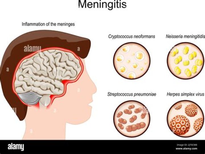 What causes cerebral meningitis?