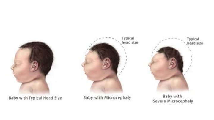 What causes microcephaly after birth?