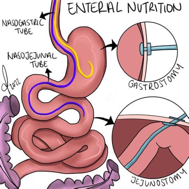 What does a enterotomy do?