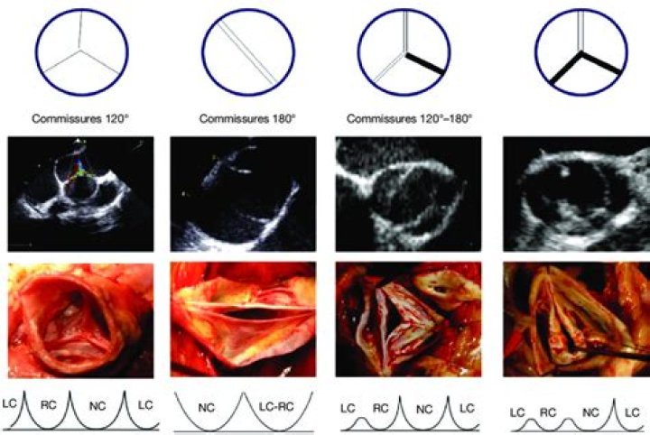 What does commissural mean?