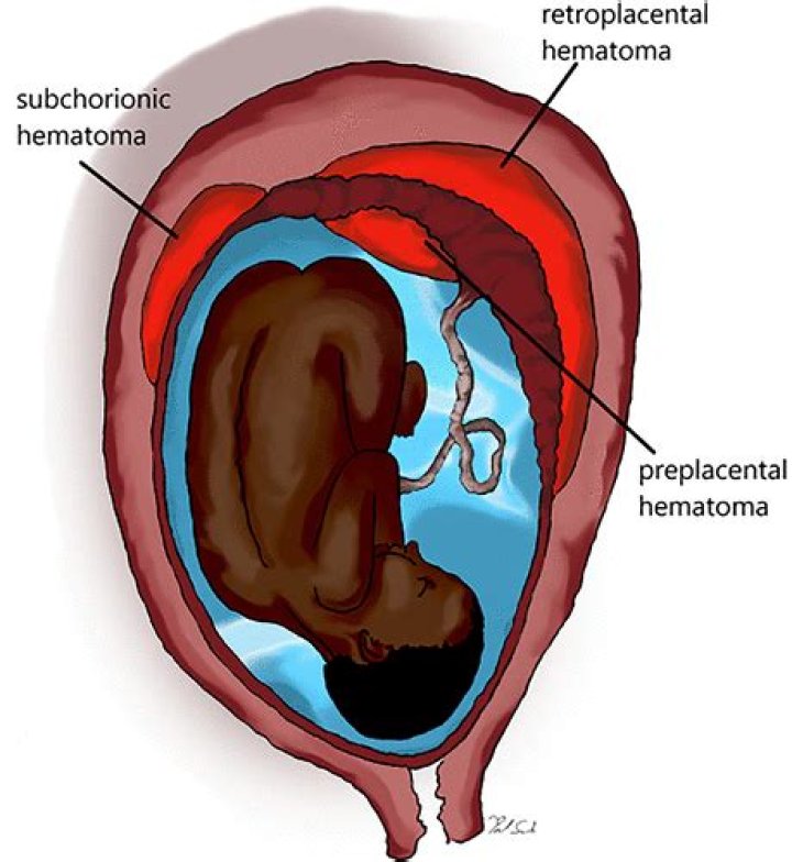What is a small hematoma?